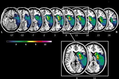 Preserved but Less Efficient Control of Response Interference After Unilateral Lesions of the Striatum